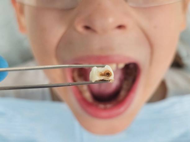 Best Emergency Root Canal Treatment in Huntsville, AR